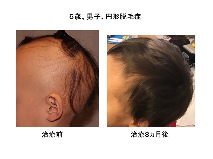 円形脱毛症　病院""